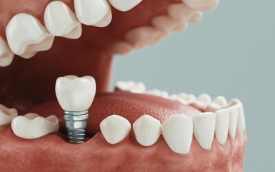 Precio de los implantes dentales en Córdoba: guía completa