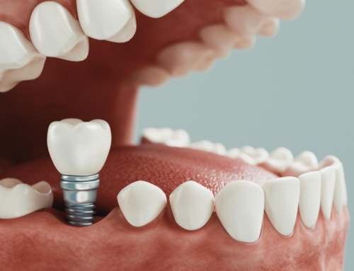 Precio de los implantes dentales en Córdoba: guía completa