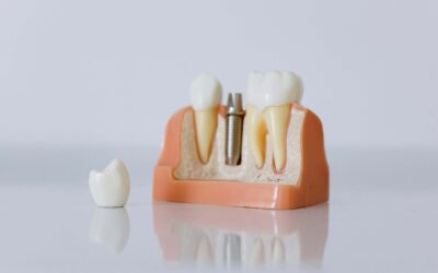 ¿Cuántos tipos de implantes dentales existen y cuál es el más adecuado?