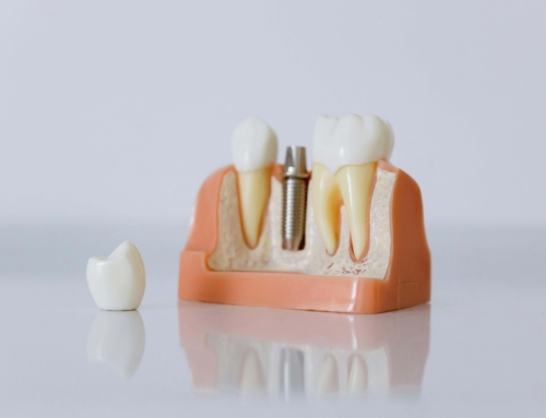 ¿Cuántos tipos de implantes dentales existen y cuál es el más adecuado?