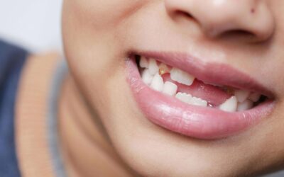 Qué dientes se caen primero en los niños
